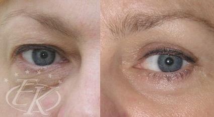 Блефаропластика верхних век пациентки доктора Кудиновой