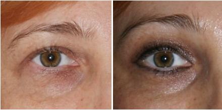 Еще один пример успешной операции по блефаропластике верхних и нижних век